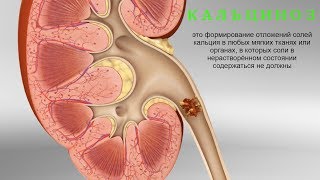 Кальциноз! Что делать? Кальциноз! Что делать?