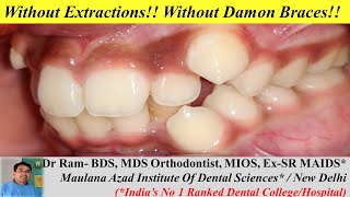 Severe Crowding Braces Treatment Without Extractions & Without Damon Braces. Full Case. Dr Ram MDS screenshot 2