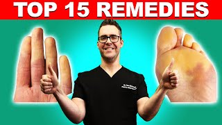 Raynauds Syndrome Top 15 Remedies Symptoms Best Treatment
