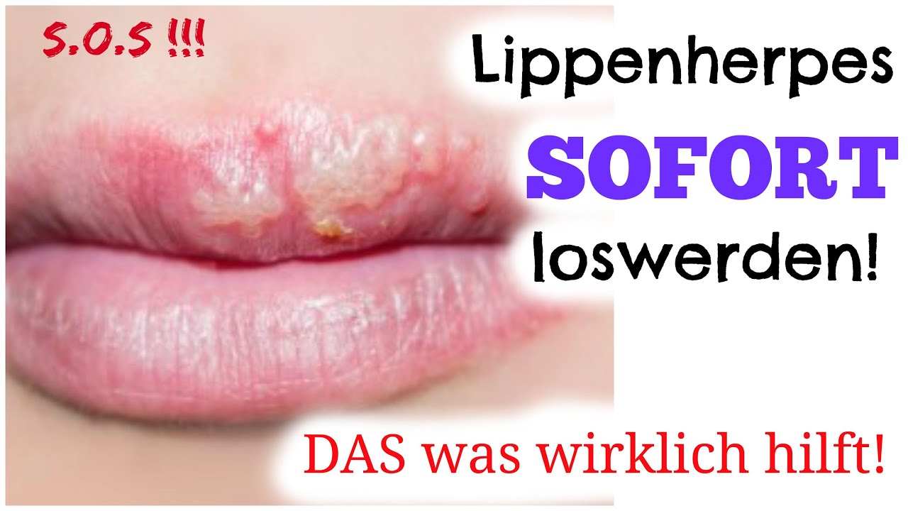 Wie Bekommt Man Herpes Am Schnellsten Weg. facebook. 