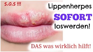 Sos Lippenherpes Sofort Beseitigen Mein Wundermittel Gegen Herpes Fieberblaschen Youtube