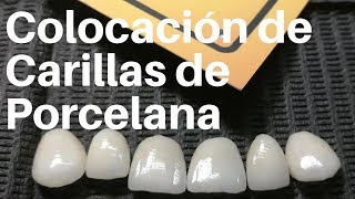 COLOCACIÓN de CARILLAS de Porcelana#carillasdentales