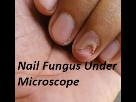 How Does A Nail Fungus Look Like Under Microscope Youtube