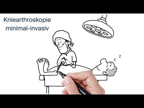 Video: Meniskektomie: Zweck, Vorbereitung, Verfahren Und Wiederherstellung