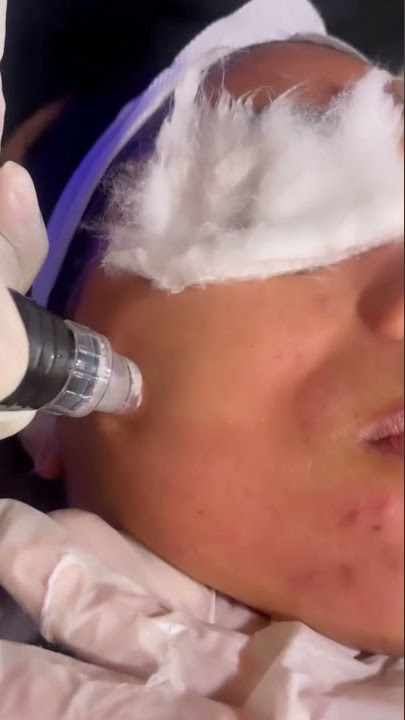 Glycopeel treatment for brighter skin #shorts #short #glycopeeltreatment #skinwhitening 09711150928