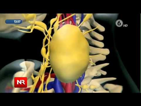 Video: Linfoma (linfosarkom)
