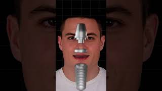 Missing a Tooth? Dental Implants Explained | Best Tooth Replacement Solution