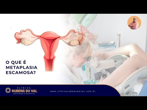 Vídeo: Metaplasia escamosa significa câncer?