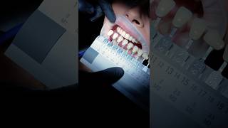 Why Is the Hollywood Smile So Popular? The Truth Behind the Perfect Smile ✨