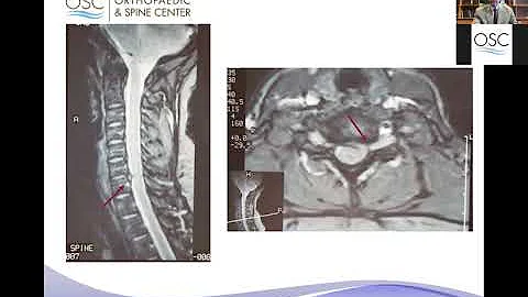 Treating Painful Issues of the Spine with Dr. Jeff...