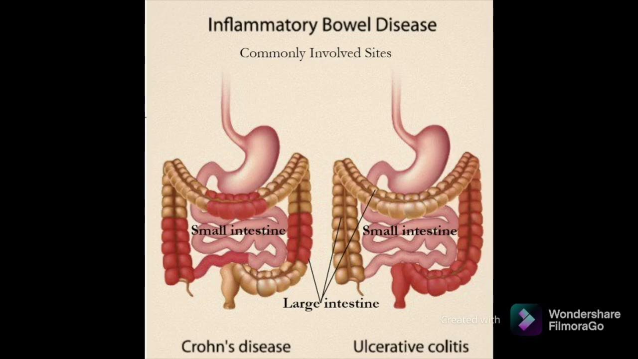 Colon irritable o enfermedad de crohn