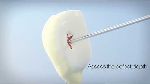 BioPoly Patella Procedural Animation