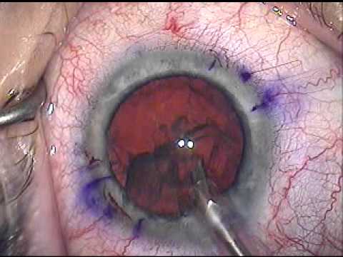 Modern Cataract Surgery Acrysof Toric Implant and LRI, Michael Sayegh, MD.mpg