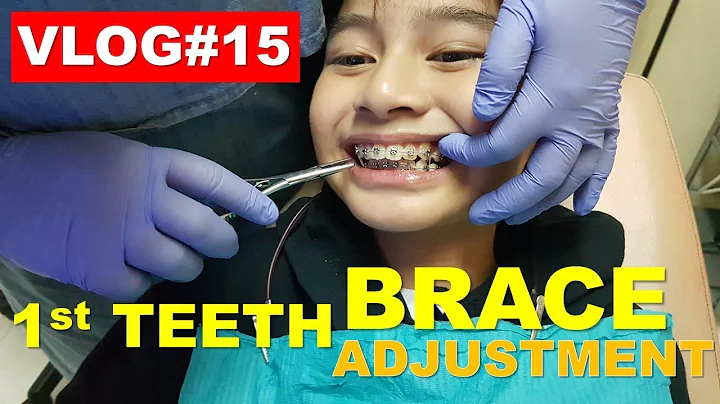 1st Teeth Brace adjustment: : Kenneth Gutierrez | ...