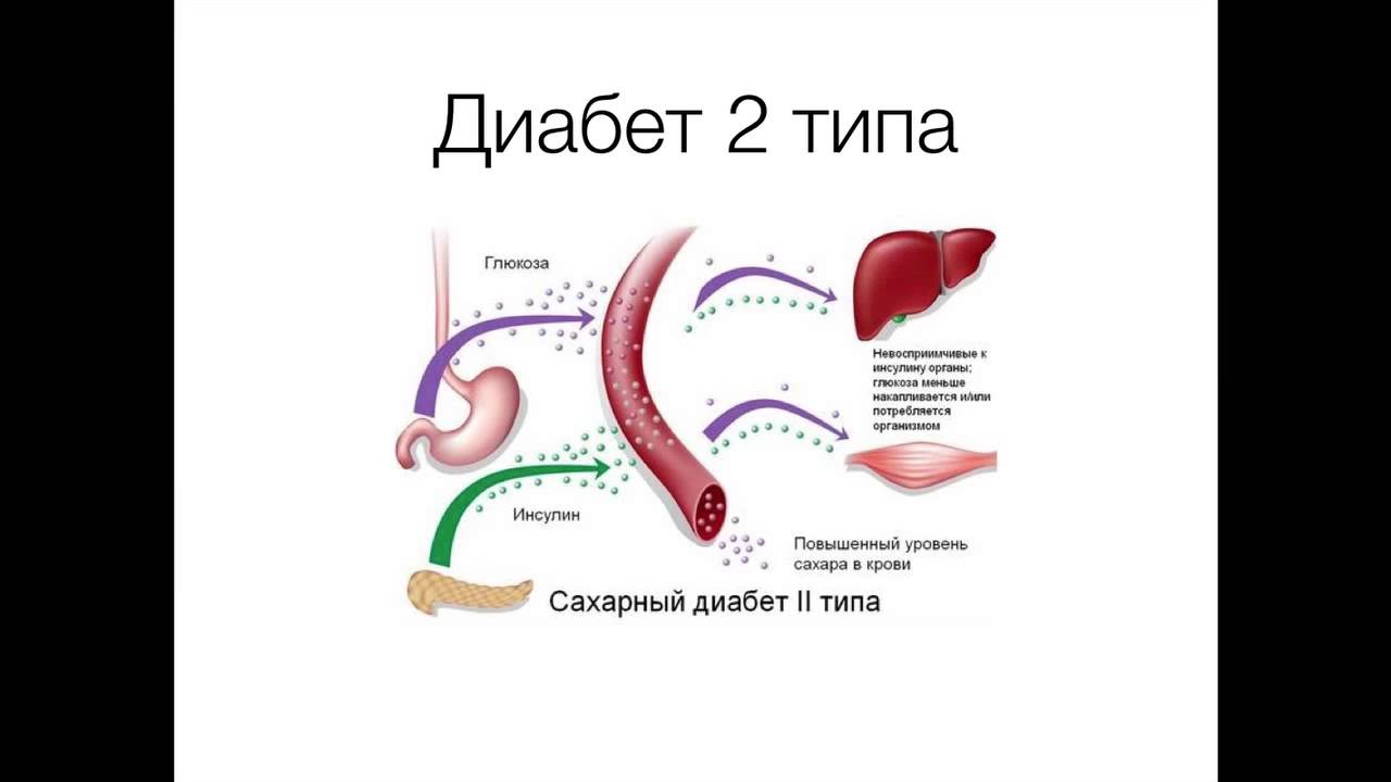 Сахарный диабет 2 типа виды. Сахарный диабет 2 типа. Сахарный диабет второго типа рисунок. Сахарный диабет 2 типа язык. Сахарный диабет 2 типа схема.