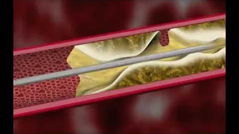 CSI Peripheral Arterial Disease Atherectomy at CVI in Southern California