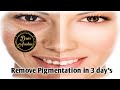 Remove pigmentation in 3 days dear anabias saloon