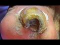 Onychomycosis Curls Into Holes, With Dry Residue Flying Everywhere【Xue Yidao】