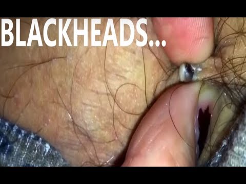 George's Goldmine of Blackheads, Cysts and Whitehead Popping (NSFE)