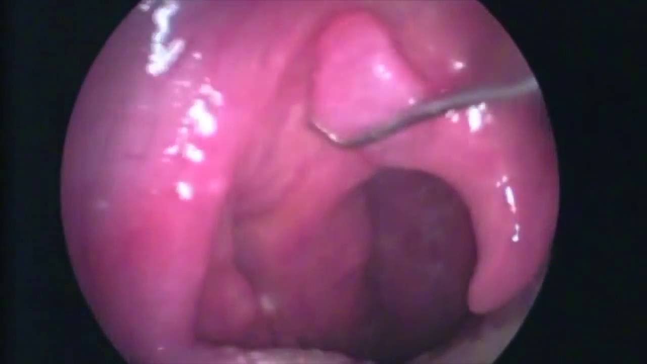 Papiloma uvula benigno, Dieta în timpul tratamentului pentru paraziți