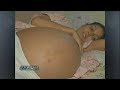 Una mujer adquiriÃ³ un gran abdomen presuntamente por pastillas para adelgazar