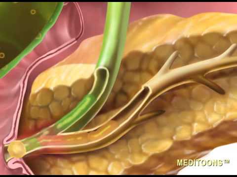 Gallstone Pancreatitis (Gallstone) - Meditoons™ - YouTube