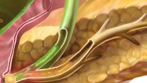 Gallstone Pancreatitis (Gallstone) - Meditoons™