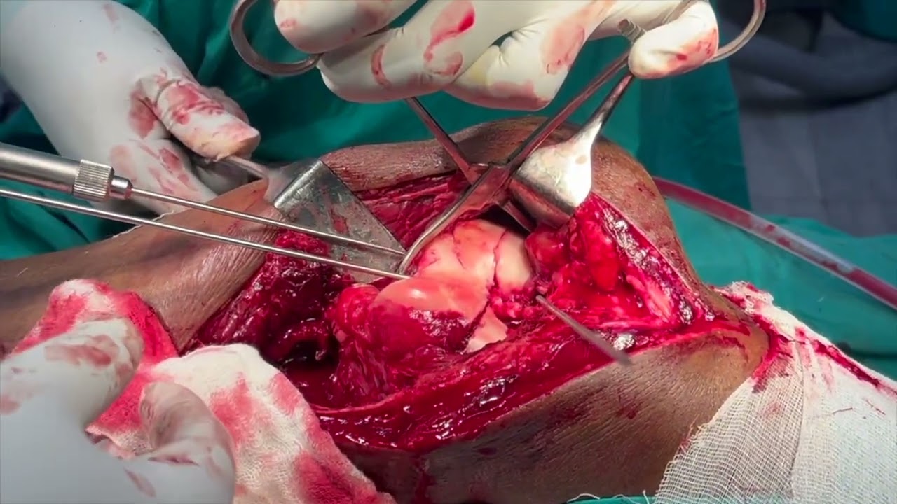 distal femur orif video -- sunit hazra, rgkar, kolkata, 9830074273