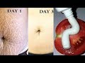 Get Rid Of Stretch Marks Super fast and Permanently, How To Get Rid of Stretch Marks Fast