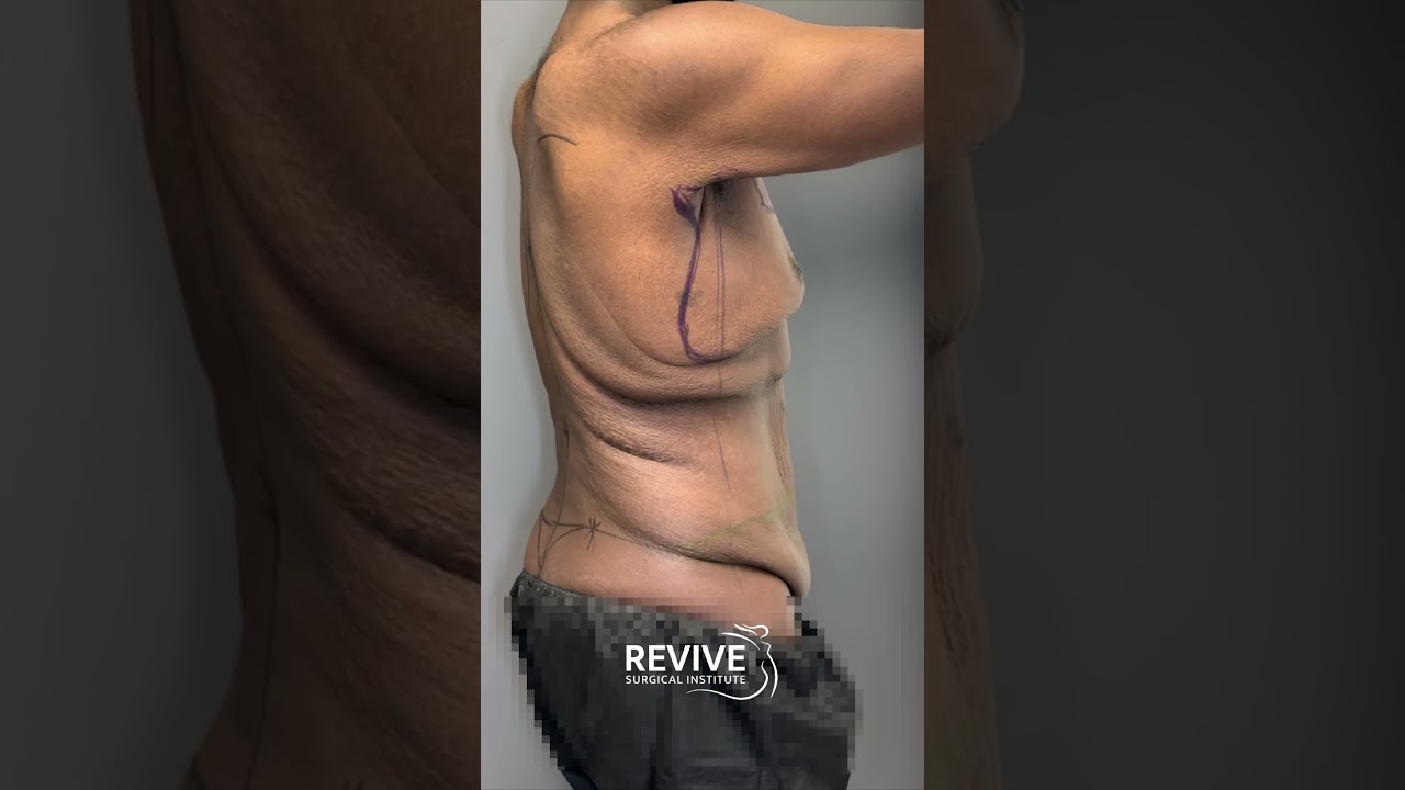 Male Massive Weight Loss Surgery - Gynecomastia & Tummy Tuck