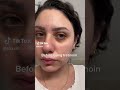 Tretinoin results after one month retinol retina