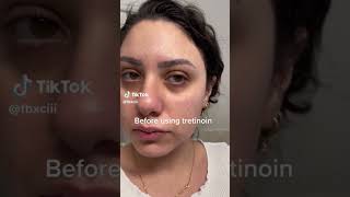 Tretinoin Results After One Month 