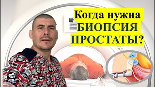 БИОПСИЯ ПРОСТАТЫ. КОГДА НУЖНА? КАК ВЫПОЛНЯЕТСЯ? ОСЛОЖНЕНИЯ!!!