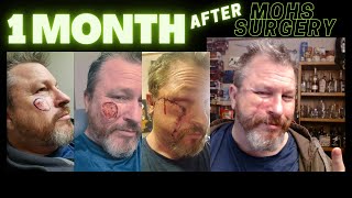 Last update on my Skin Cancer Surgery Mohs Surgery Skin Flap  Facial Reconstruction