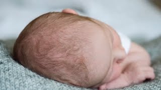 Craniosynostosis: Everything you need to know with Dr. Alberto Hernandez