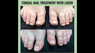 Cured Nail Fungus With Laser Treatment (photos included)