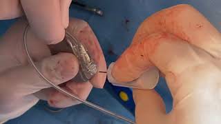 Tips and tricks for Permanent pacemaker implantation via Lt anterior thoracotomy, in a redo case