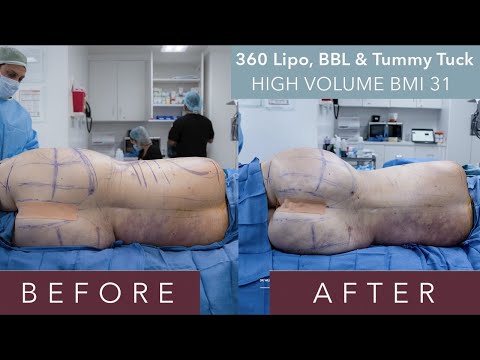 High Volume 360 Liposuction, Vaser Lipo, BBL J-Plasma Skin Tightening & Tummy Tuck, BMI 31