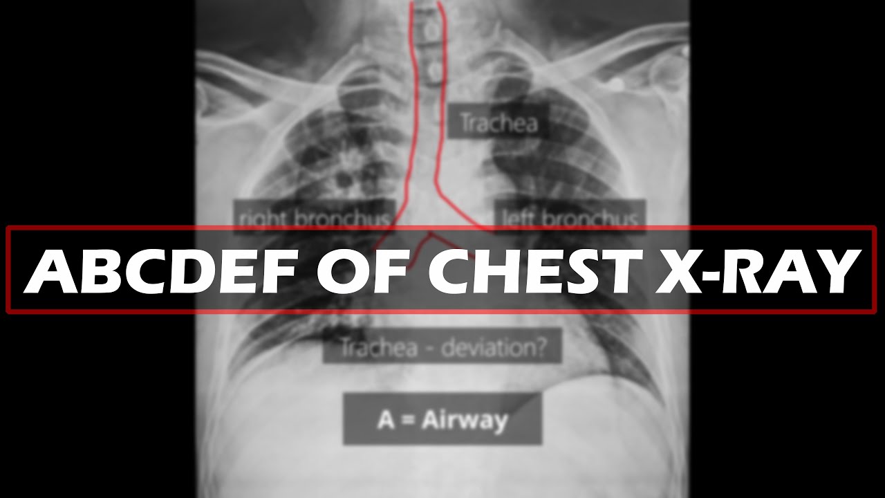How To Read A Chest X Ray ABCDEF Of CXR YouTube How To Read A Chest X Ray ABCDEF Of CXR YouTube
