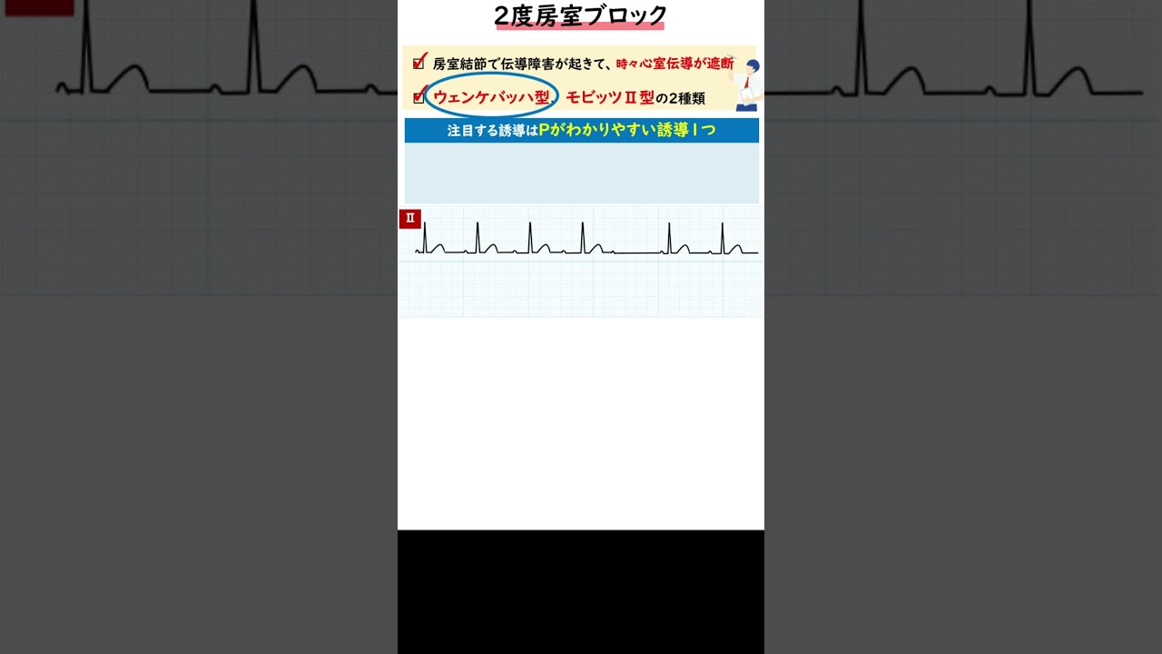 聞き流し1分心電図【2度房室ブロック ウェンケバッハ型