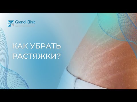 Как убрать растяжки (стрии)