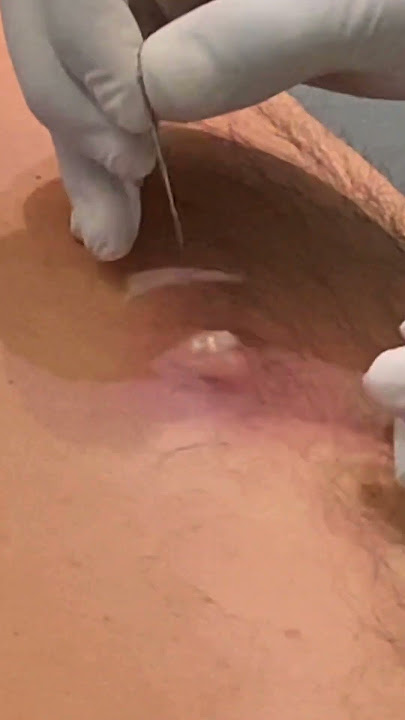 PUS-FILLED ABSCESS!