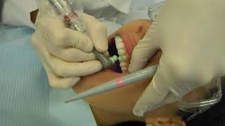 Coronalrubber Cup Polish Anterior Teeth