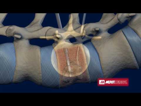 STAR Tumor Ablation System