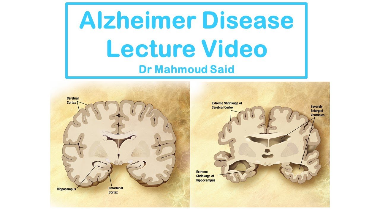 Alzheimer’s disease  شرح & Dementia Lecture مرض الزهايمر و الخرف شرح