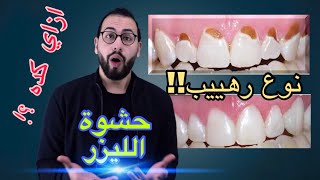 ?شرح طريقة وضع الحشوات التجميلية علي الاسنان ( الحشو الذي احدث طفرة في طب الاسنان )  composite