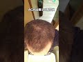 aga治療19週間後#shorts#aga#薄毛#チャップアップ#発毛