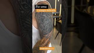 Fiz uma cirurgia delicada! #remocaodetatuagem #tatuagem #antesedepois #cobertura #reforma