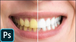 Yellow to White Teeth