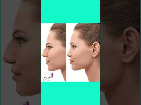 Rinoplastia - casos de éxito